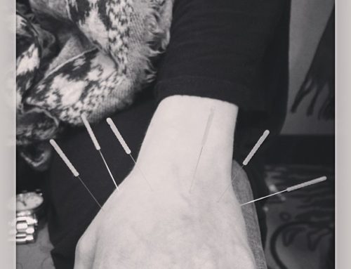 Acupuncture for headaches